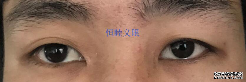 林先生佩戴更換義眼片，保留眼球，眼球萎縮